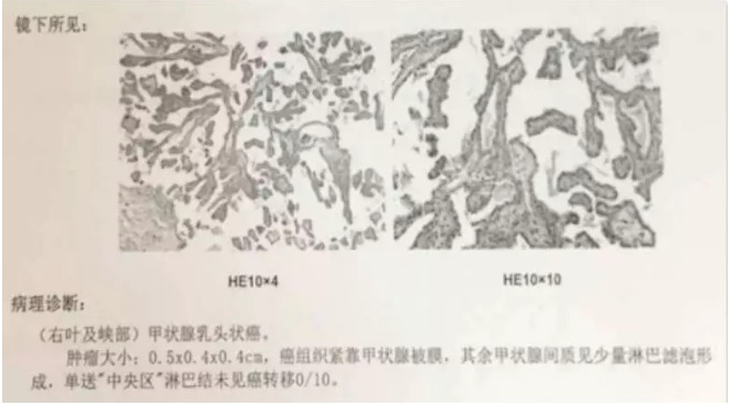 別慌，甲狀腺疾病還可以這樣投保！